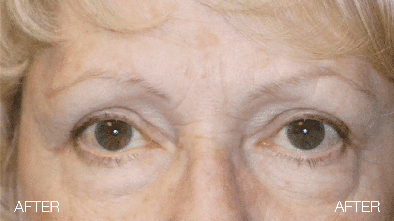 Blepharoplasty After