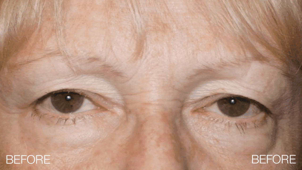 Blepharoplasty Before