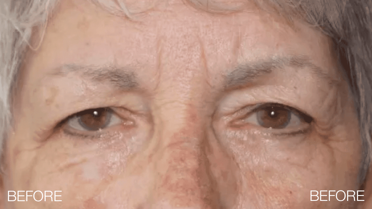 Blepharoplasty & Brow Lift Before