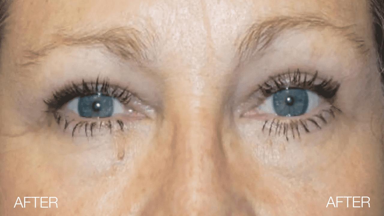 Blepharoplasty After