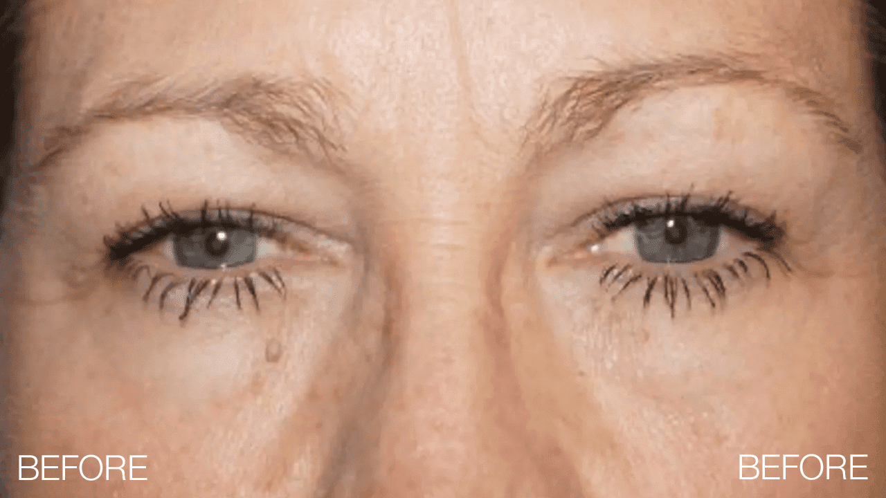 Blepharoplasty Before