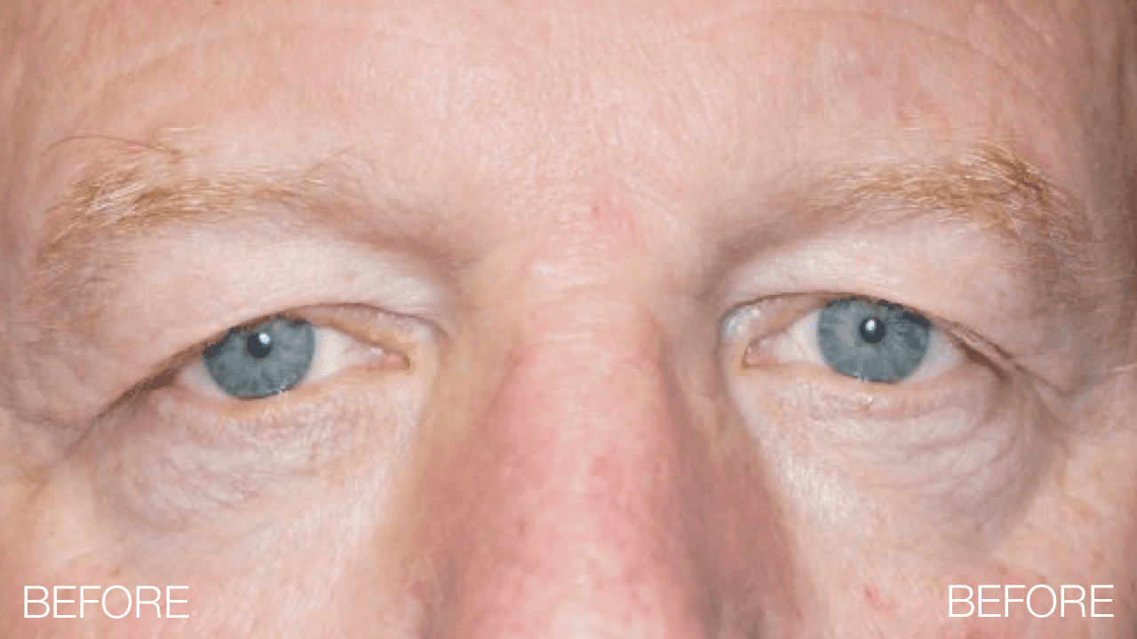 Blepharoplasty Before