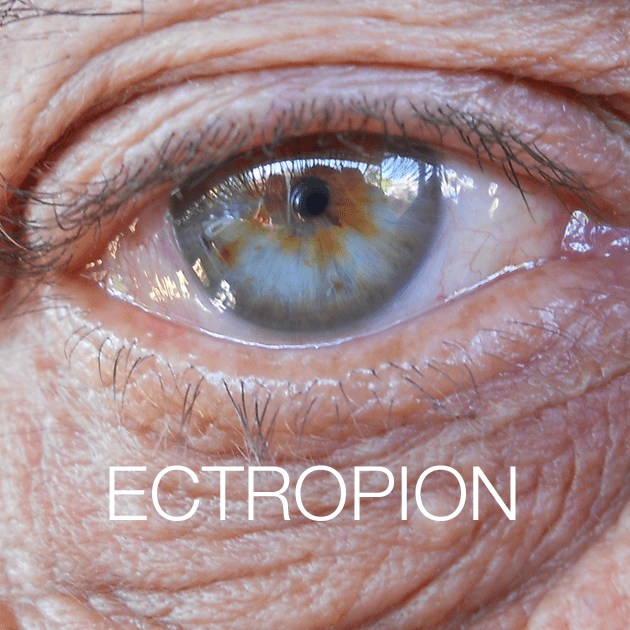 Ectropion And Entropion Eyecare Virginia Beach 7463