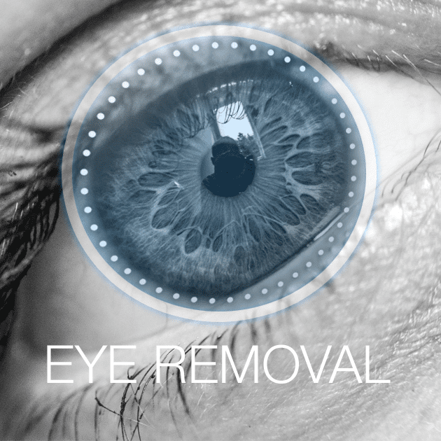 Eye Removal Eyecare Virginia Beach